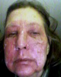 An allergist or dermatologist examines red spots on. This Is For Anybody With Hives Simpleunhookedliving