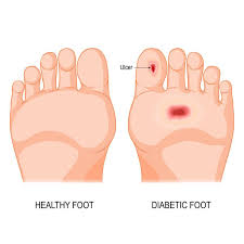 Image result for diabetic toes