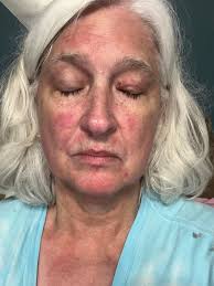 What do AlphaGal skin reactions look like?