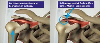 Flach (typ i), gebogen (typ ii) oder hakenförmig (typ iii = hooked akromion) mrt: Impingement Syndrom Schulter Mainklinik