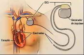 Un desfibrilador automático implantable (dai), o desfibrilador interno, es un aparato a través del cual, se hace circular una corriente eléctrica brusca y de alto voltaje para detener y revertir las arritmias. Desfibrilador Automatico Implantable Dai En La Region De Murcia Cuidados De Enfermeria Pagina 2 De 3 Revista Electronica De Portales Medicos Com