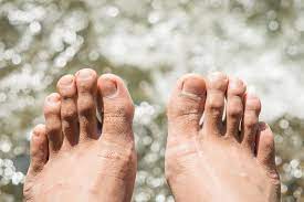 Try to alternate pairs of shoes, heat them and vent them after using. 9 Tips For Preventing Athlete S Foot This Summer City Podiatry Podiatrists