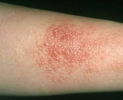 Image result for contact dermatitis
