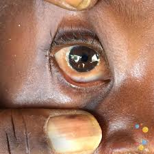 Image result for Conjunctivitis