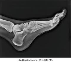 Image result for Foot XRay