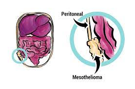 Maybe you would like to learn more about one of these? Peritoneal Mesothelioma Treatment Prognosis Diagnosis