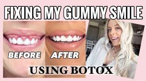 When you smile, do you feel the appearance of your upper teeth is overshadowed by excessive gum tissue? Botox For Gummy Smile Youtube