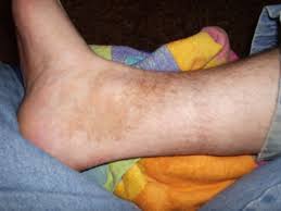 Image result for Pigment stains on the shin