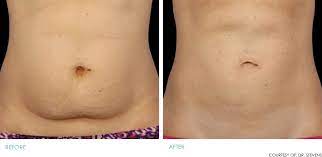 187,458 likes · 383 talking about this · 1,346 were here. Coolsculpting Fat Freezing Avie Medspa Leesburg Va