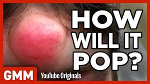 Eliminate all these annoyances with proper solution to each species. How Will This Pimple Pop Game Ft Dr Pimple Popper Youtube