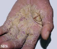Image result for scabies norvegica