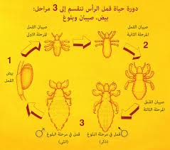 ما هي أسباب ظهور قمل الرأس وكيف تتخلص من الصيبان طب تايم