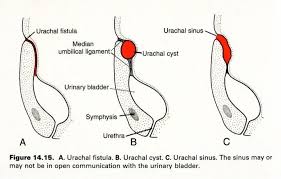 Urachal Cyst Google Search Cysts Bladder Sinusitis