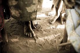 Madura foot is a localized, chronic, progressive infection of the skin and subcutaneous tissues, usually containing abscesses, granulomata, or both. Mycetoma Chromoblastomycosis And Other Deep Mycoses