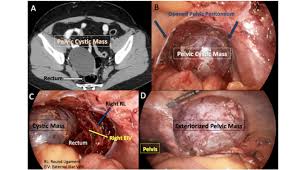 Laparoscopic Excision Of An Unusual Pelvic Mass