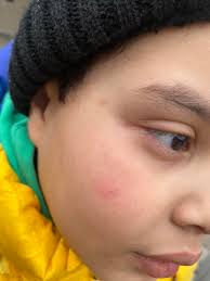 Apologize for your child's fractured ankle at school