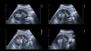 Chronic kidney disease, also called chronic kidney failure treatment for chronic kidney disease focuses on slowing the progression of the kidney damage, usually by controlling the underlying cause. End Stage Renal Disease Symptoms Life Expectancy And More
