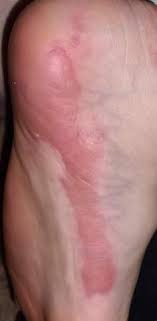 Roter Flache Flecken Am Fuss Gesundheit Und Medizin