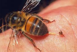 Slideshow Summer Skin Hazards Stings Bites Burns And More Remedies For Bee Stings Bee Sting Allergy Bee Sting