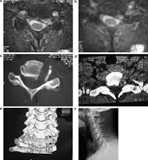 Symptoms can vary depending on which disc has herniated and which nerve root has become pinched or inflamed. Hernia De Disc Cervicala