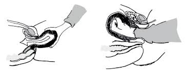 Image result for Uterine Inversion