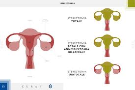 Isterectomia Laparoscopica Vantaggi E Controindicazioni Gemelli Curae