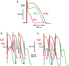 Image result for Early Repolarization
