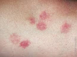 Image result for bedbugs bites
