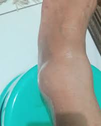 Biaya Pengobatan Cedera Engkel Sprain Ankle Mahal Untold Story