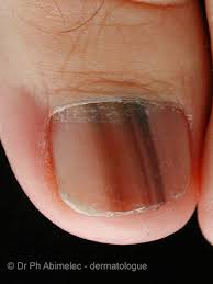 Image result for Acral lentiginous melanoma nail