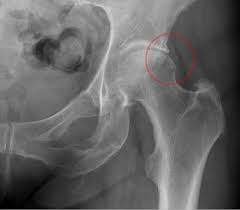 Image result for Hip XRay