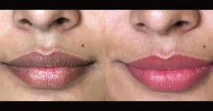 Berhenti merokok setelah menjadi terlalu aktif sebelumnya memang tidaklah gampang. Bibir Pucat Dan Gelap Seperti Juwita Healthy Sdn Bhd Facebook