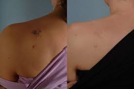 Laser Tattoo Removal Little Rock Ar Dr Suzanne Yee