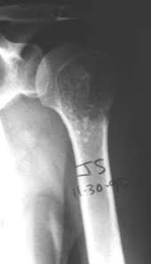 Image result for Chondrosarcoma