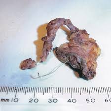 I had a suture granuloma in my lower pelvic area located directly under the edge of my incision from a rectal resection. Granuloma Formation Around A Retained Perclose S Suture Presenting 12 Months After Implantation Journal Of Vascular And Interventional Radiology