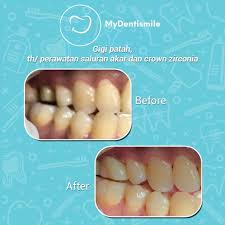 Beli tang cabut gigi online berkualitas dengan harga murah terbaru 2021 di tokopedia! Perawatan Saluran Akar Untuk Atasi Sakit Gigi Yang Parah Mydentismile