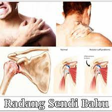 Saya pernah divonis terkena gastritis akut. Rumah Sakit Universitas Ahmad Dahlan Nyeri Bahu Bahu Terdiri Atas Kumpulan Beberapa Sendi Yang Disatukan Oleh Tendon Dan Otot Sehingga Memungkinkan Kita Melakukan Berbagai Gerakan Pada Lengan Mulai Dari Menggaruk