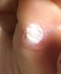 Learn what causes plantar warts and how to treat and prevent them. Home Remedy For A Plantar Wart Because Evidently I M Gross The Art Of Doing Stuff