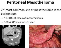 Lung cancer is a leading type of cancer — and a leading killer — in the united states every year. Peritoneal Mesothelioma Wikitechy