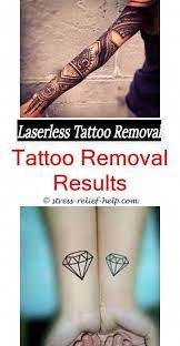 The Best Tattoo Removal Does Removing A Tattoo With Salt Work How Much Does Laser Tattoo Removal Tattoo Removal Results Custom Temporary Tattoos Tattoo Removal