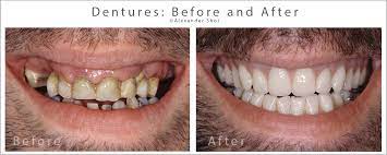 Dentures are replacements for missing teeth that can be taken out and put back into your mouth. Dentures Before After Seattle Shor Dental