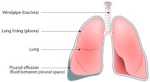 Image result for Parapneumonic Effusion