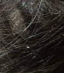 Sind Das Nissen In Mein Haar Haare Lause
