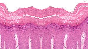 Image result for Neurodermatitis