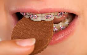 Perubahan gigi setelah memakai behel selama 9 bulan & bedanya roth, ceramic, damon braces. Elak Makan 4 Jenis Makanan Ini Kalau Tak Nak Braces Rosak