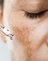 Image result for Melasma