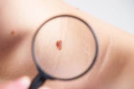 Melanomas can be curable when caught and treated early. The Abcs Of Skin Cancer Usa Health