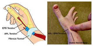 Image result for Intersection Syndrome