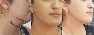 Lipolyse/ texas lift