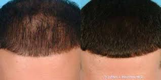 Prp before and after gallery. Prp Treatment For Hair Loss Ahb